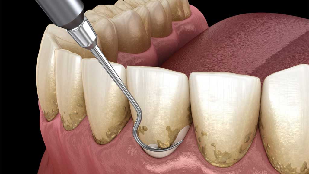 بهترین دندانپزشک کورتاژ لثه در شیراز