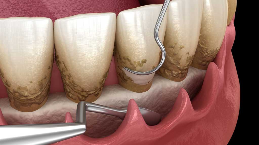 بهترین دندانپزشک کورتاژ لثه در شیراز